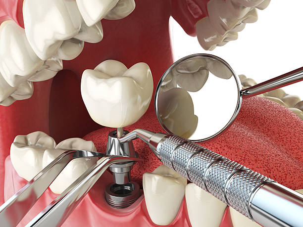 Best Emergency Dental Services for Seniors in Solana Beach, CA